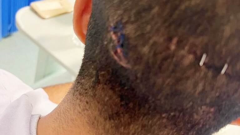 Stitches in the victim's head.
