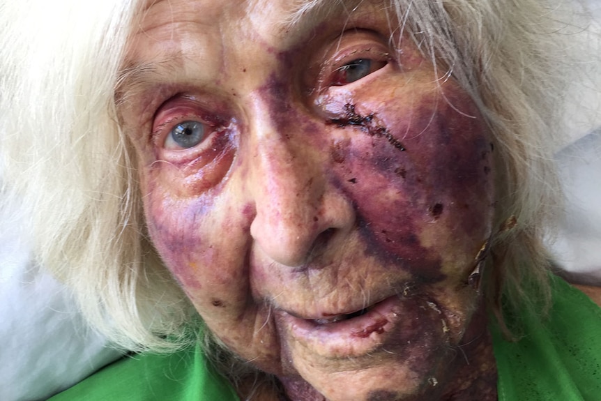 Clare Alexa Wilson, then 92, lies in a bed with facial injuries, recovering from being attacked in her Mount Isa home.