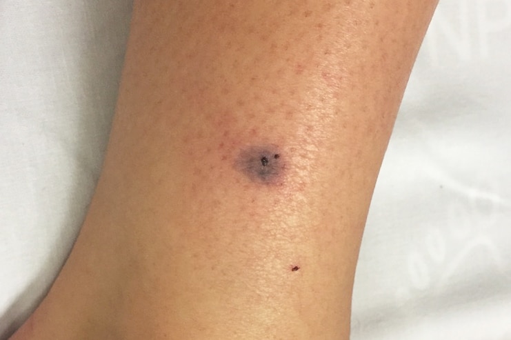 A bite wound on the leg of Jorji Harper after she was bitten by a tiger snake.