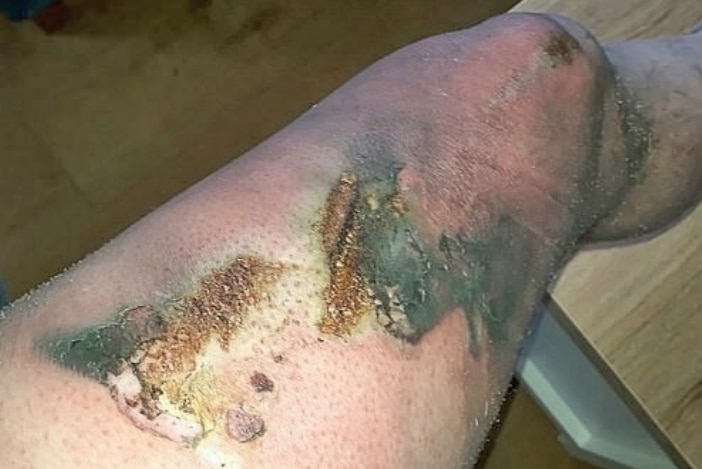 Explosion of e-cigarette battery inside worker's pocket compared to 'fireworks going off'