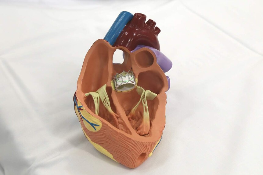 A model of the transcatheter aortic valve implantation (TAVI) valve in the heart.
