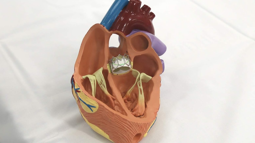 A model of the transcatheter aortic valve implantation (TAVI) valve in the heart.