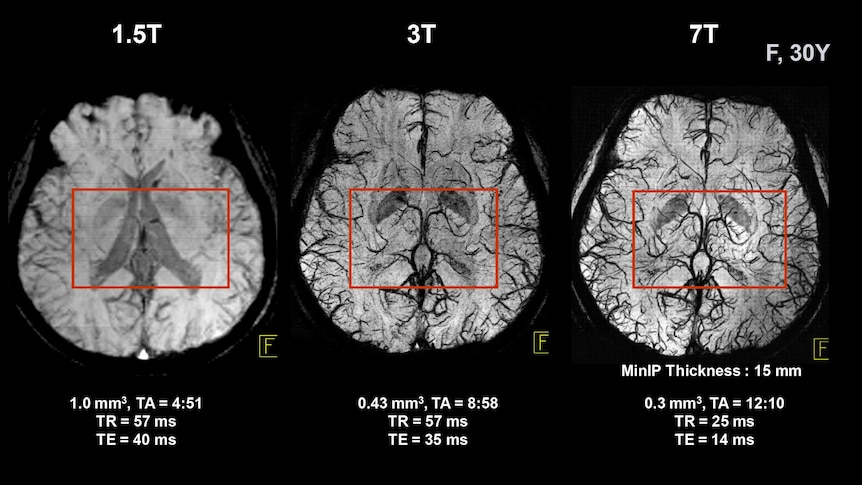 Brain scans showing the difference between a 1.5 Tesla MRI, 3 Tesla and 7 TeslaMRI