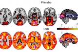 Brain scans show effects under placebo and LSD
