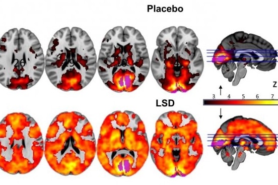 Brain scans show effects under placebo and LSD