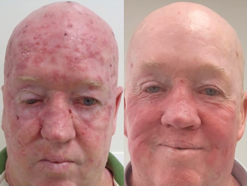 A before and after image of a man treated for skin cancers on his head
