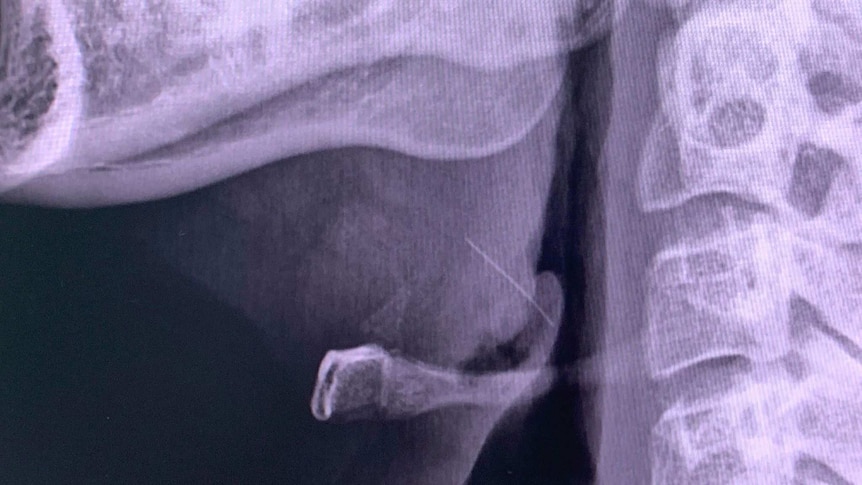 X-ray of the wire bristle caught in a man's throat.