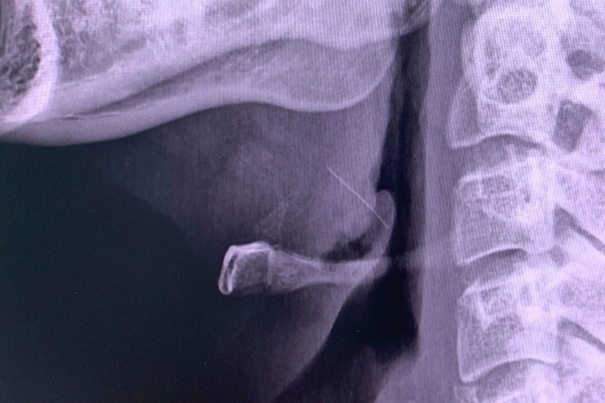 X-ray of the wire bristle caught in a man's throat.