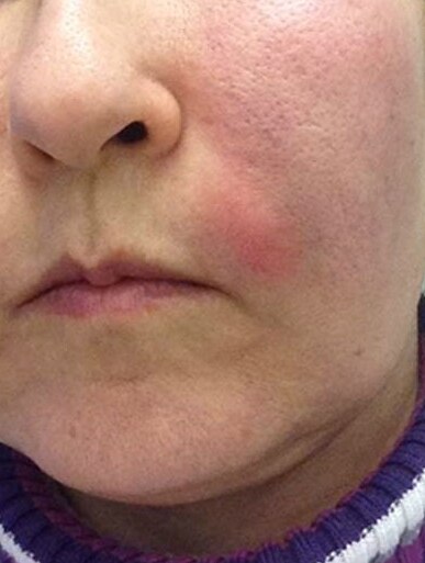 An unidentified woman's swollen face after undergoing a vampire facial