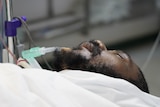 A man under anaesthetic lays on an operating table with his eyes closed, a breathing tube in his mouth