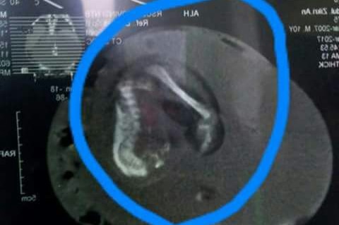 X-ray showing the twin foetus inside the abdomen of a 10-month-old baby boy.