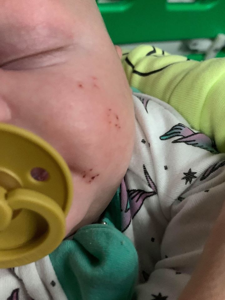 A close up on baby Hamish's face, which has snake bites on it.