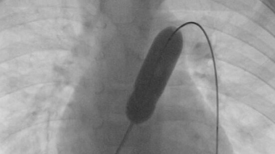 A catheter inside a heart during surgery.