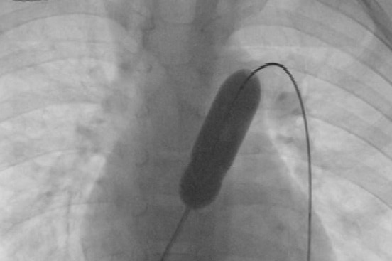 A catheter inside a heart during surgery.