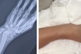 Sally Pearson's X-ray next to picture of broken wrist