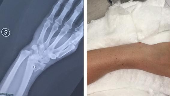 Sally Pearson's X-ray next to picture of broken wrist