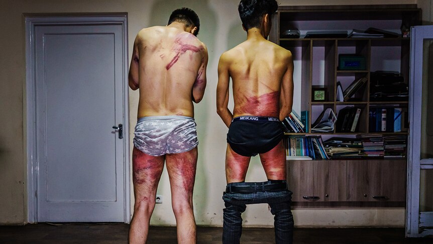 Two male journalists with large bruises to their body.