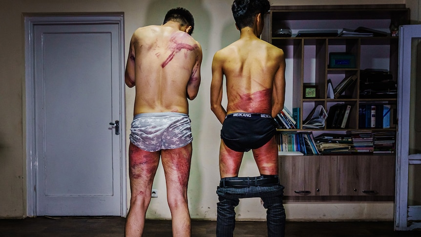 Two male journalists with large bruises to their body.