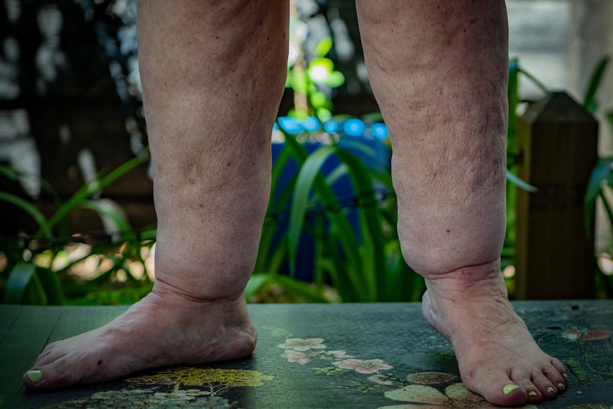 A close up of Dee's legs below the knees, which look dimpled and swollen, and her bright yellow toenail polish.