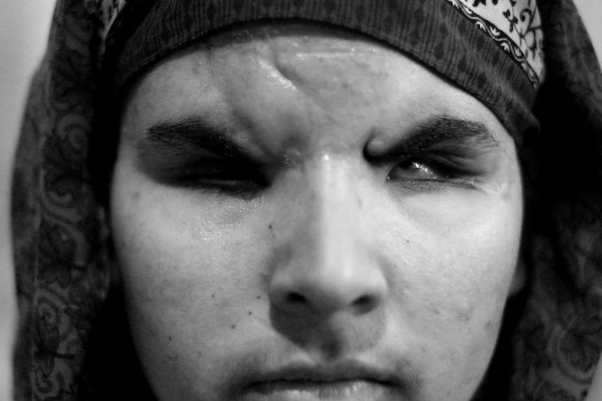 A close up of school girl Insha Mushtaq showing the injuries around her eyes.