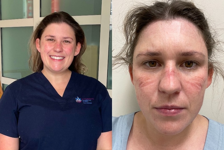 Before and after composite of an ICU nurse - on the right, she has indents on her face from wearing a mask.