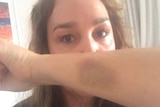 Broadcaster Kate Langbroek holds up her arm to show the bruise she sustained in a Friday night attack.
