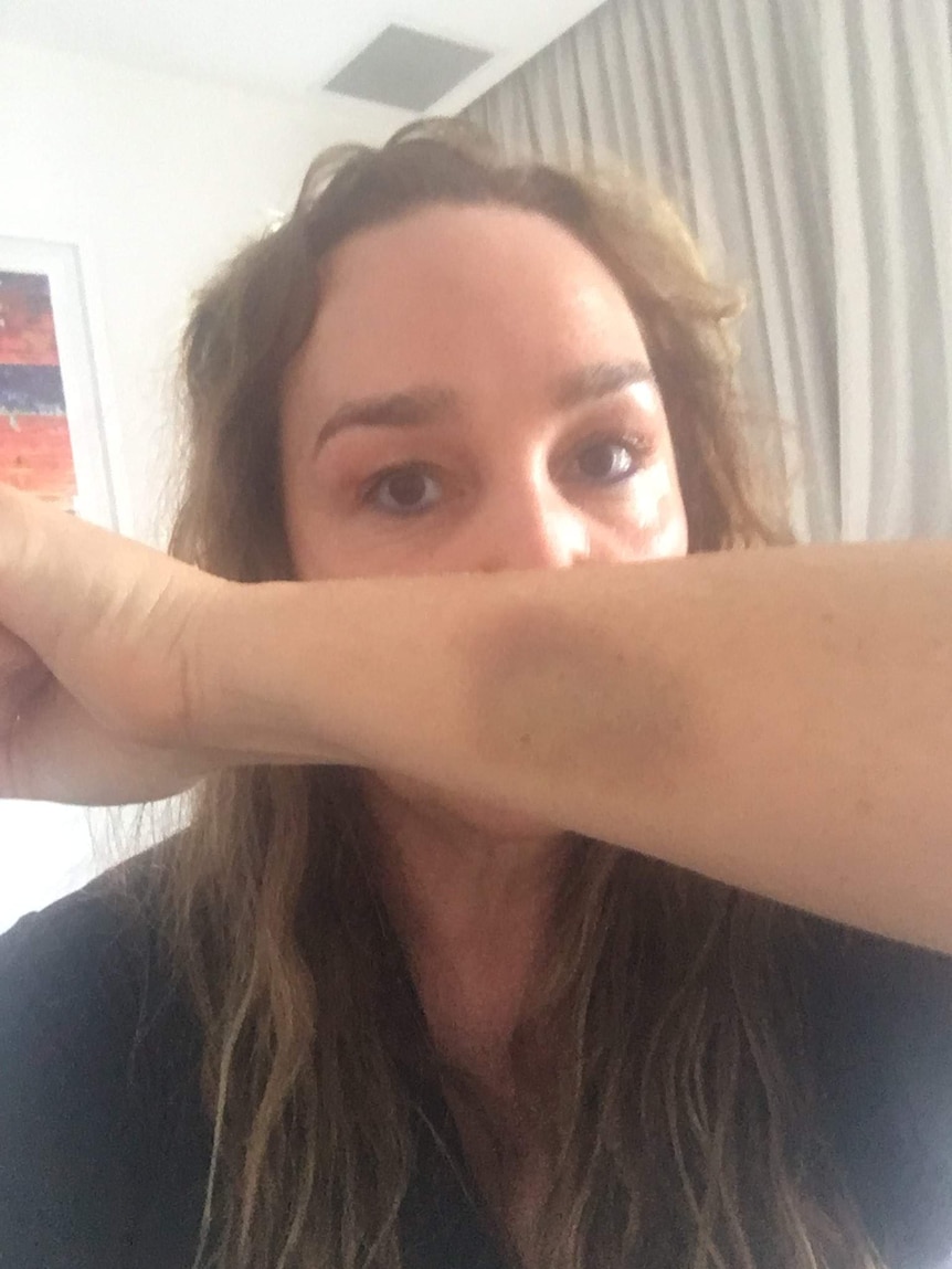 Broadcaster Kate Langbroek holds up her arm to show the bruise she sustained in a Friday night attack.