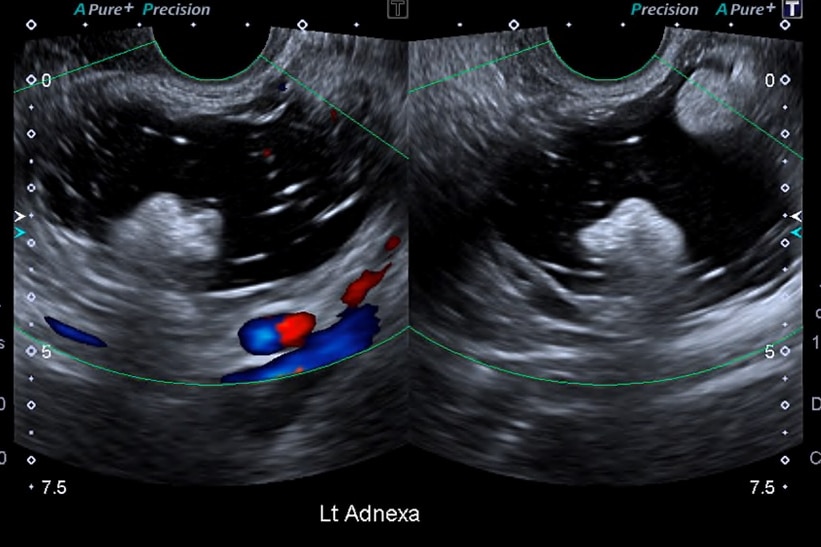 a black and white scan showing a mass on an ovary