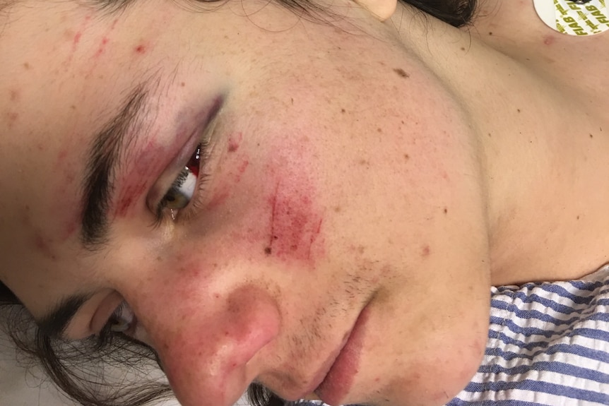 A close-up of a teen boy with facial injuries, including scrapes and a black eye.