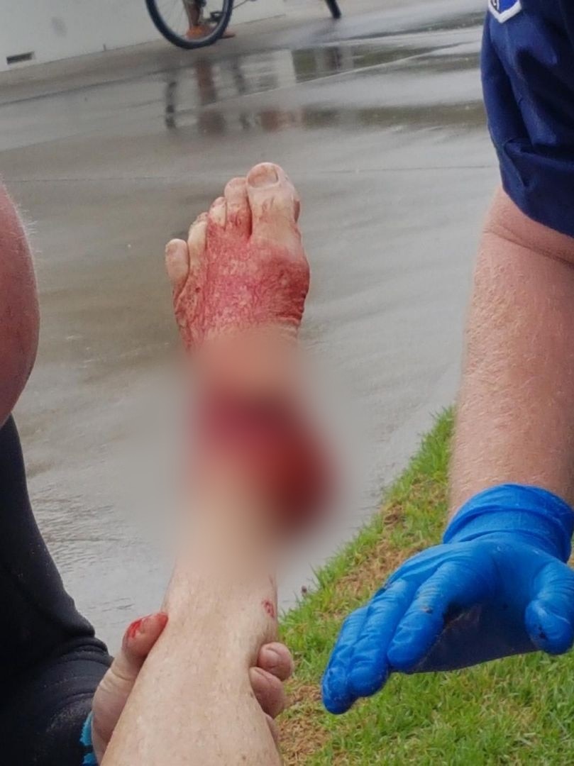 A person's left foot is covered in blood and sports a huge gash from a shark bite