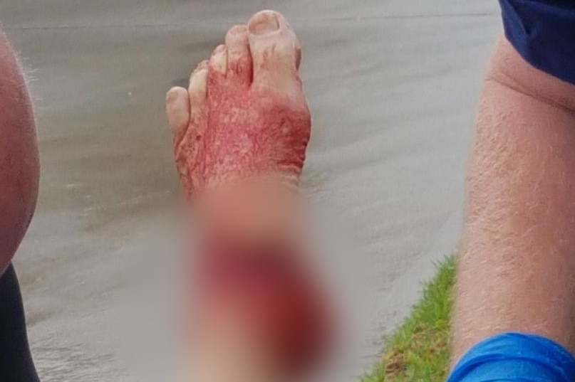 A person's left foot is covered in blood and sports a huge gash from a shark bite