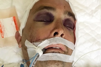 Ben French lies in a hospital bed with a bandage on his head and a tube going into his mouth.