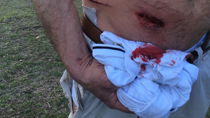 A man holds a bloody cloth next to a deep gash in his stomach