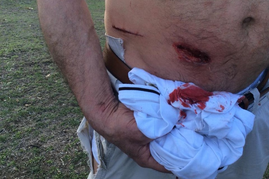 A man holds a bloody cloth next to a deep gash in his stomach