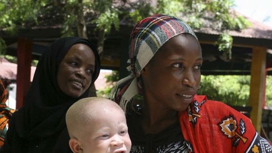 A woman holds her albino child before registering him at the office of the Tanzania Albino Society