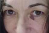 A woman's face up close with a bruise around one eye.