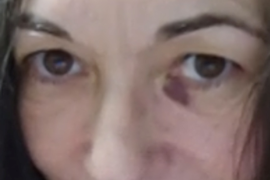 A woman's face up close with a bruise around one eye.
