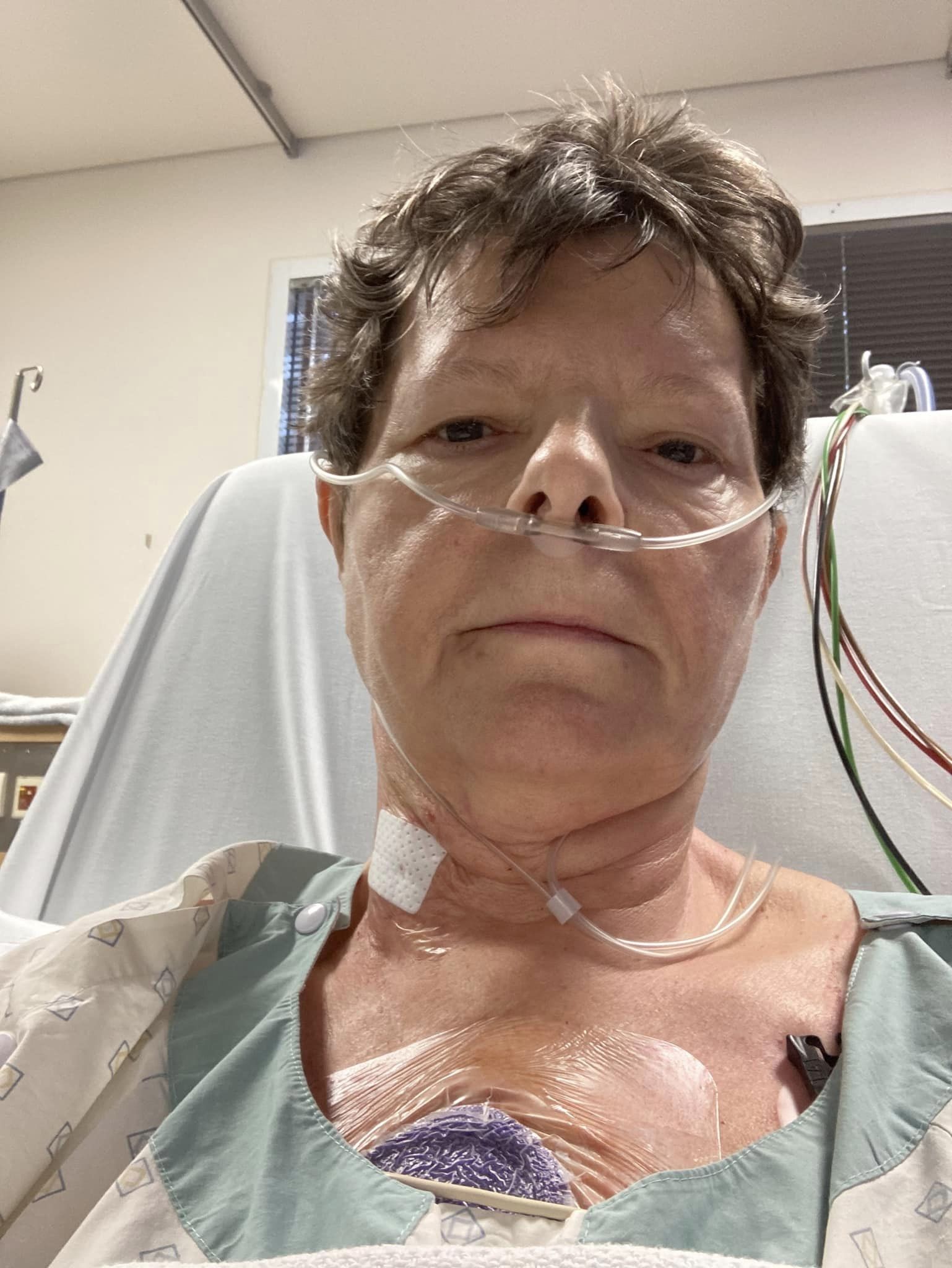 A close up of a woman's face, she has brown hair and is in a hospital bed with tubes running into her nose