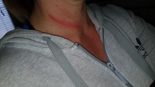 A red graze on the neck of a woman injured by fishing line.