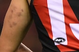 Orazio Fantasia's arm showing several bruises from where he had been pinched by his opponent Ben Stratton.